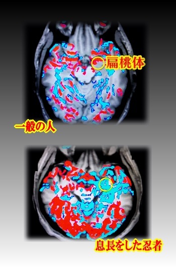 MRI画像 偏桃体